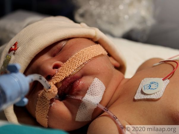 Baby of Rayeesa needs your help to survive