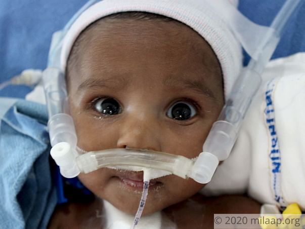 Baby of Srinivas Reneeds your help to survive