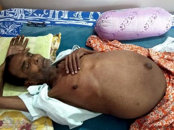 Help My Father Undergo A Liver Transplant