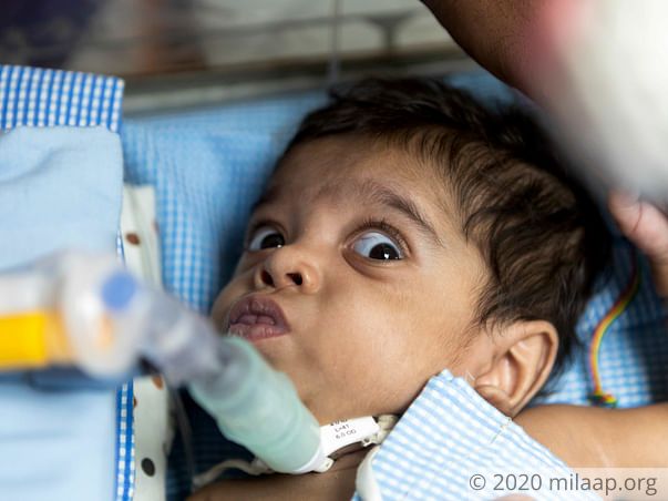 Father Lost Job While Trying To Save Baby, Needs Help To Treat Her