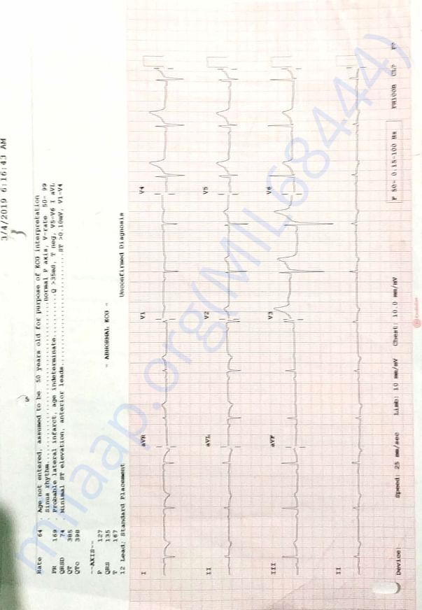 Ecg