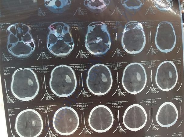 His CT scan report