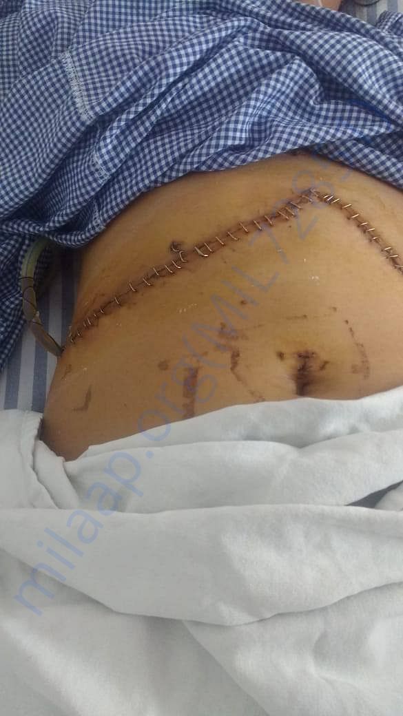 40" cut in the tummy