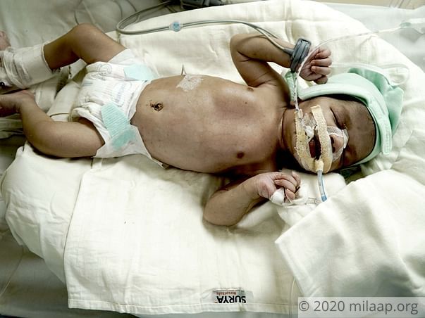 Baby of Manisha needs your help to survive