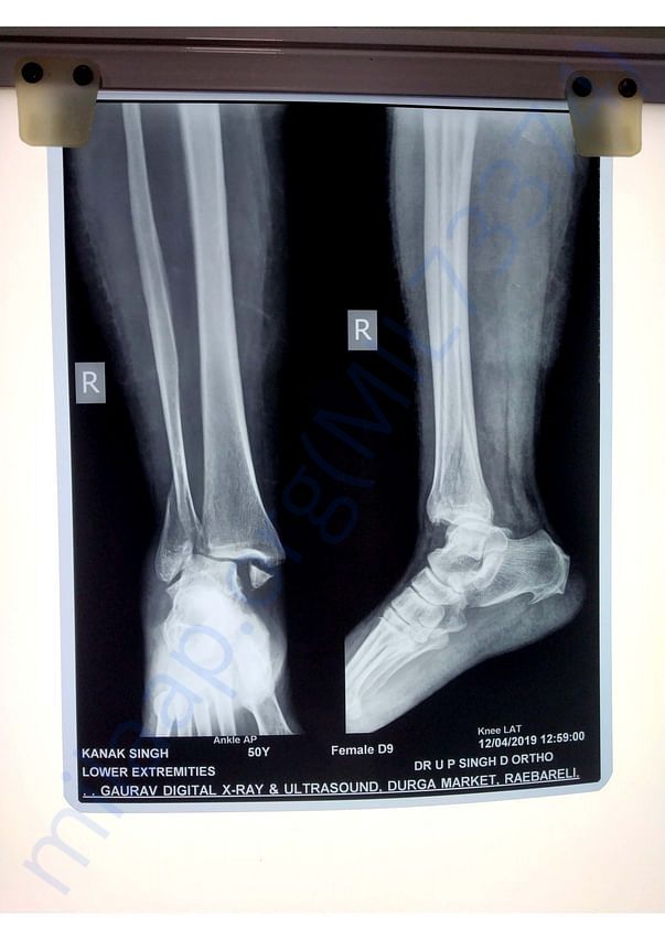 X-Ray Report - Bimalleolar fracture in right ankle