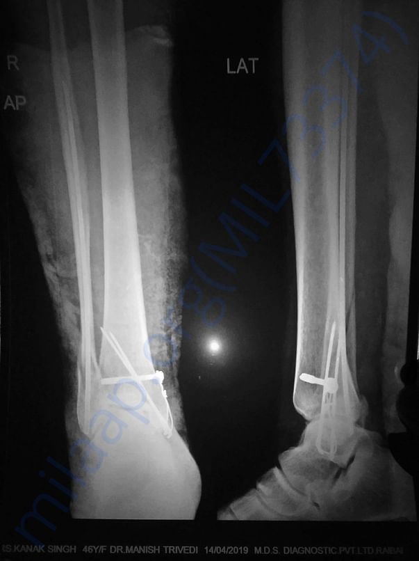CRIF Square Nailing of fibula bone & TBW of middle malleolus.