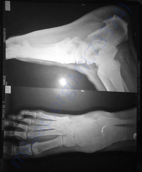 Misleading X-ray