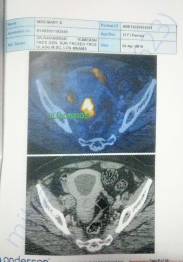 PT CT SACN 3