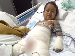 Help 4 Year Old Veda Recover From Burn Injuries
