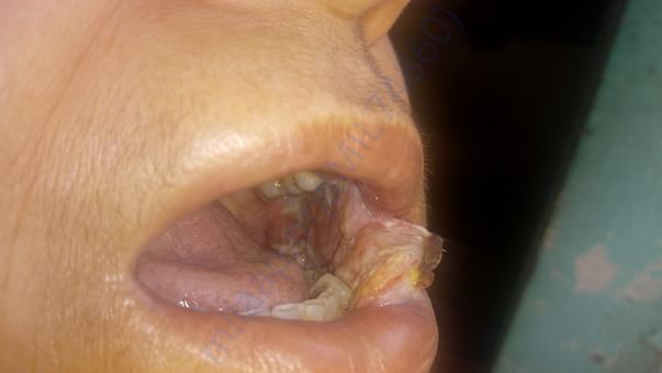 My mother condition 2