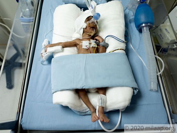 Help Jyothi's Premature Twins