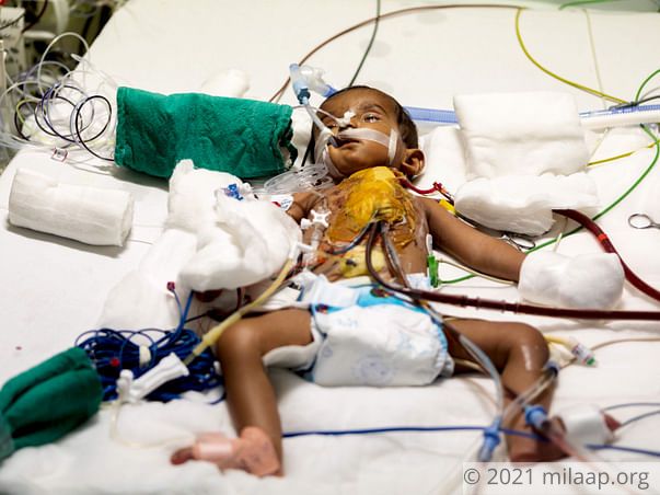 Help Baby of Mallesh Fight Congenital Heart Disease