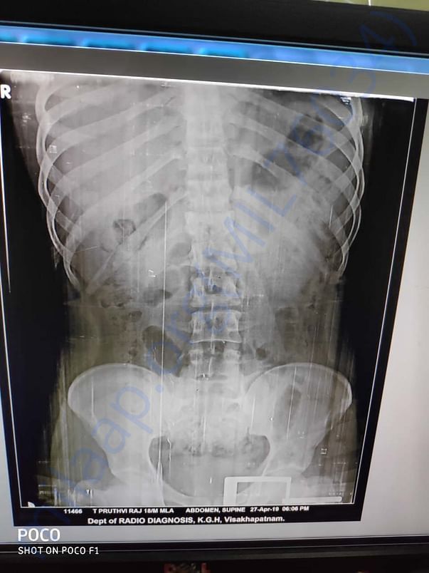 Spinal cord xray