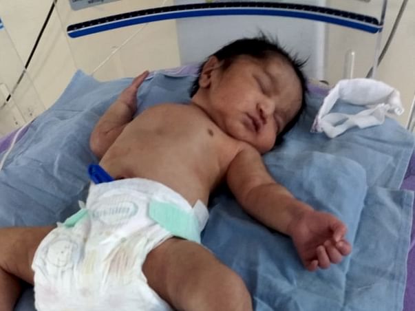 Help 2-Month-Baby Suffering From Bronchomalacia