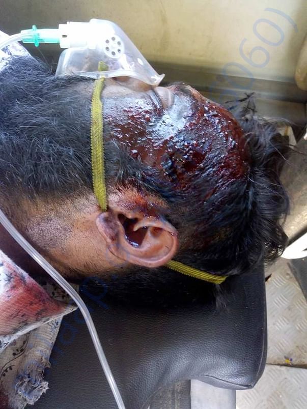Anil - after the head injury