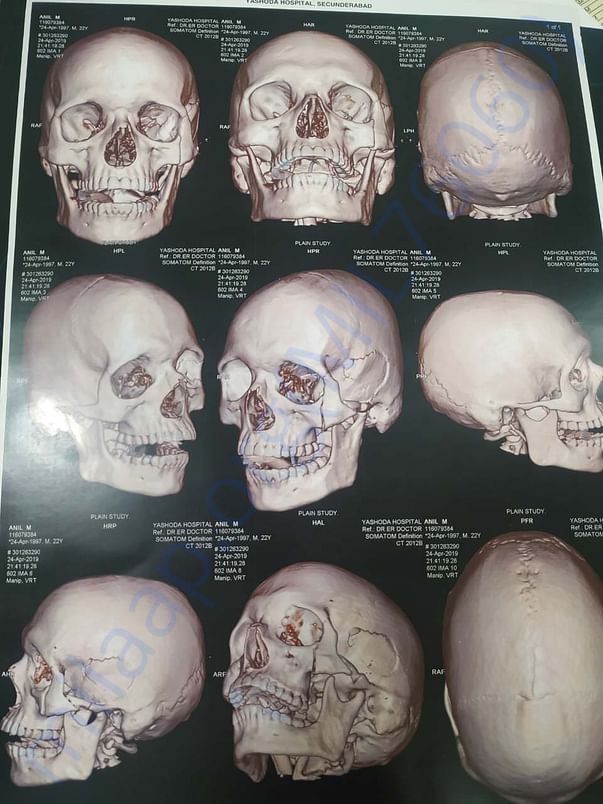 MRI scan reports- Scull broken 3 areas