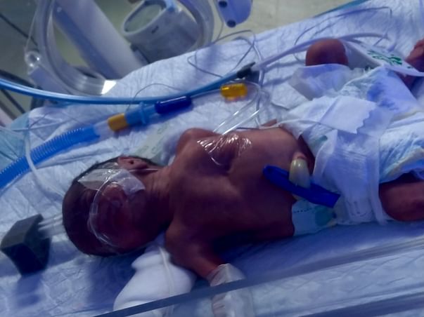 Help a 7Month Premature Baby struggling for life in NICU