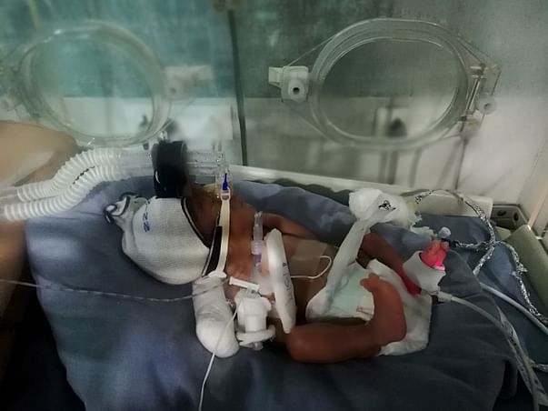 A Premature Baby Fighting A Battle To Live