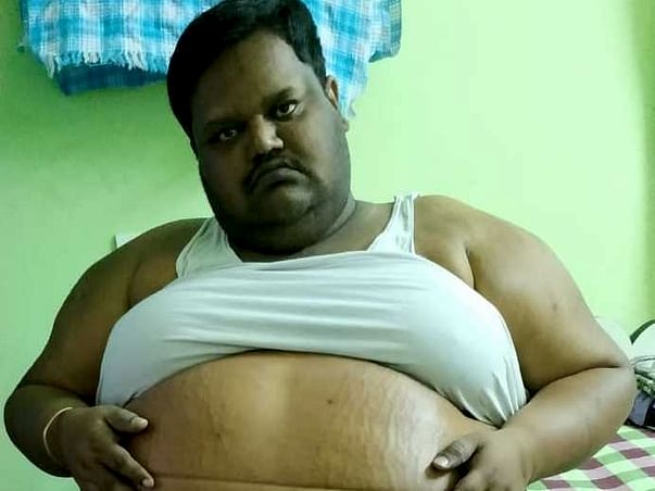 Help Naveen Goud With Morbid Obesity Stomach Filled With Water