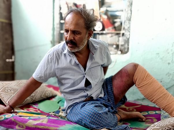 After a Bus Ran Over Man's Leg, His Family Was Brought To The Streets