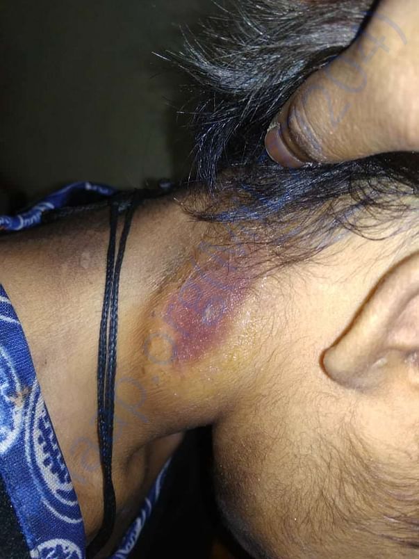 Developing Abscesses