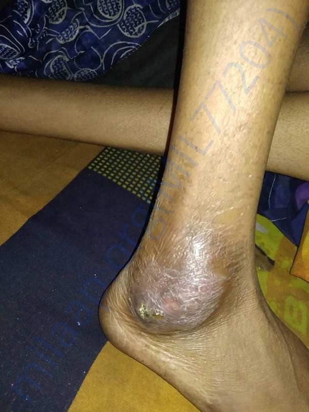 Developing Abscesses