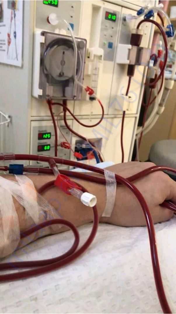 Dialysis