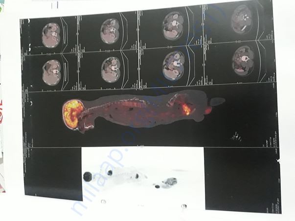 Pet scan of mridul pandey
