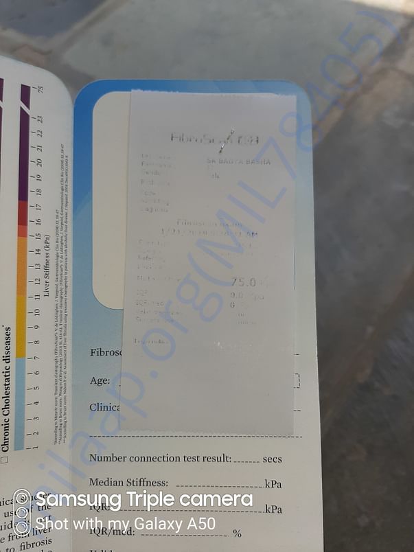 Fibro scan