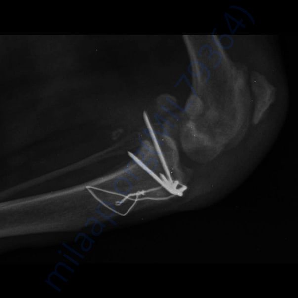 X-Ray post surgery