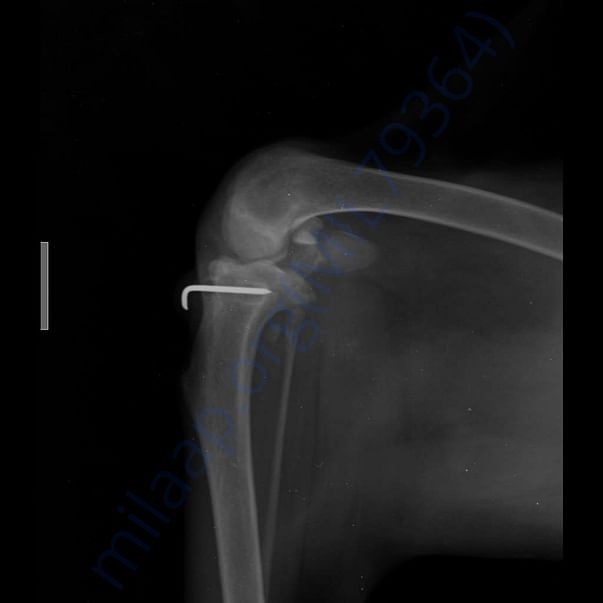 X-Ray post surgery
