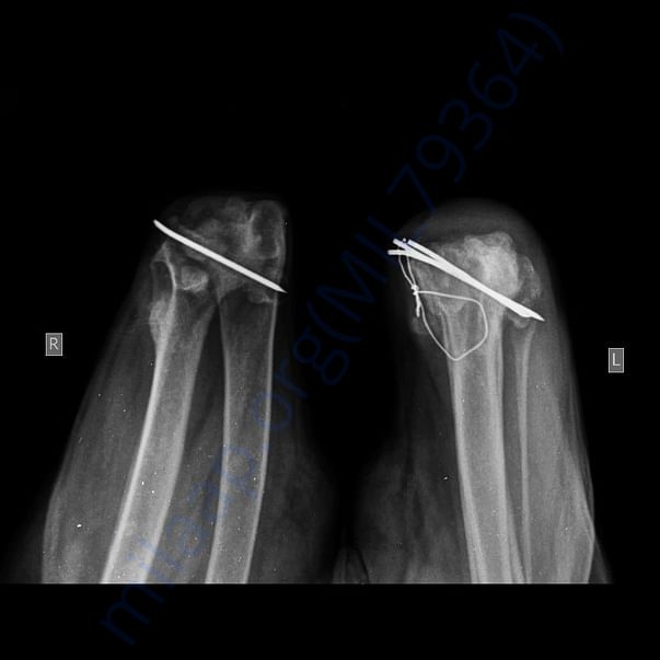 X-Ray post surgery