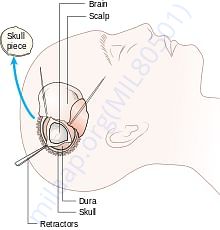 Diagram of Craniotomy