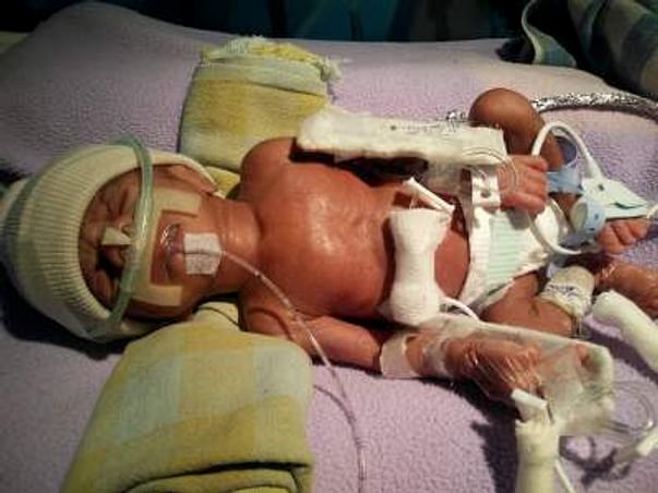 13 days baby in NICU