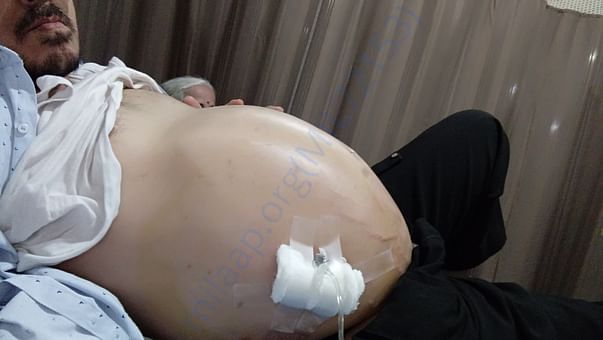 Under going LWP every week to drain out excess fluid from stomach