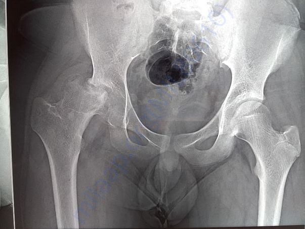 Latest X-ray