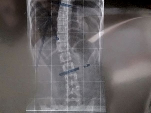 Help greeshama(spinal bend)