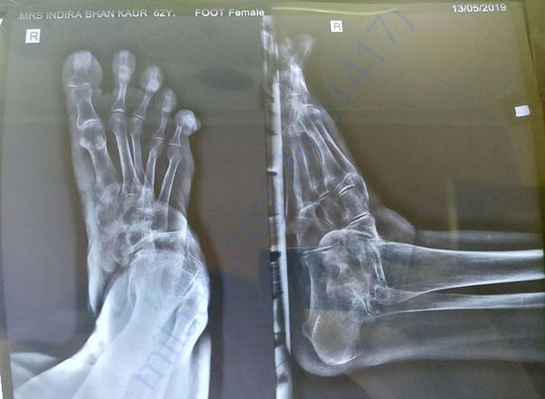 X-Ray