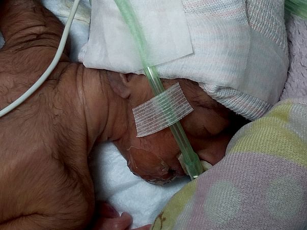 Help for my premature baby of low birth weight due to born at 28 weeks