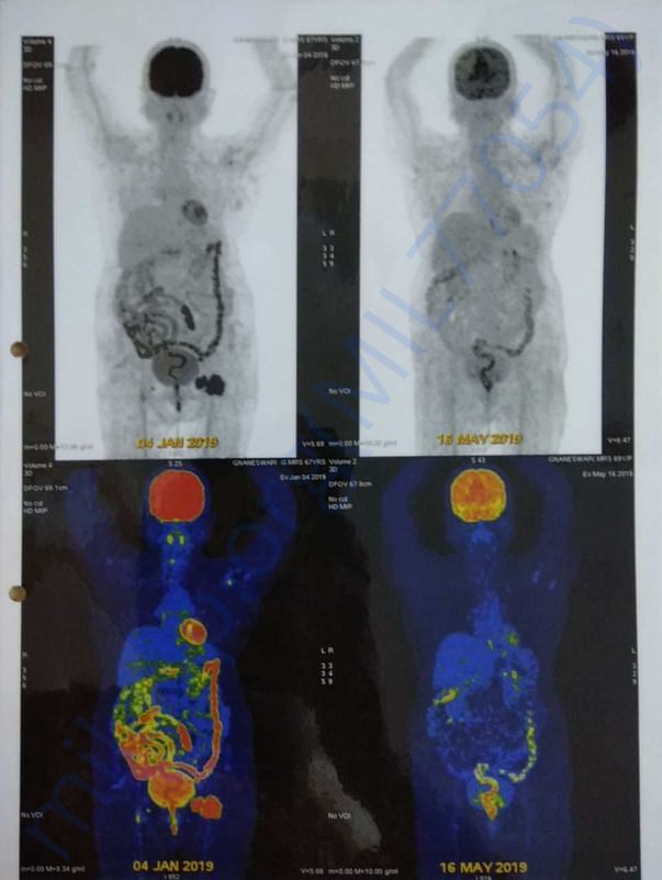 here i attached the recent scan report of my mother