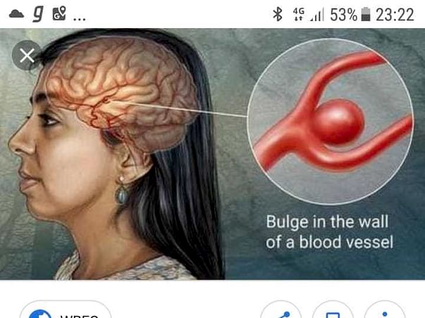 Help my mother recover from Brain Aneurysm