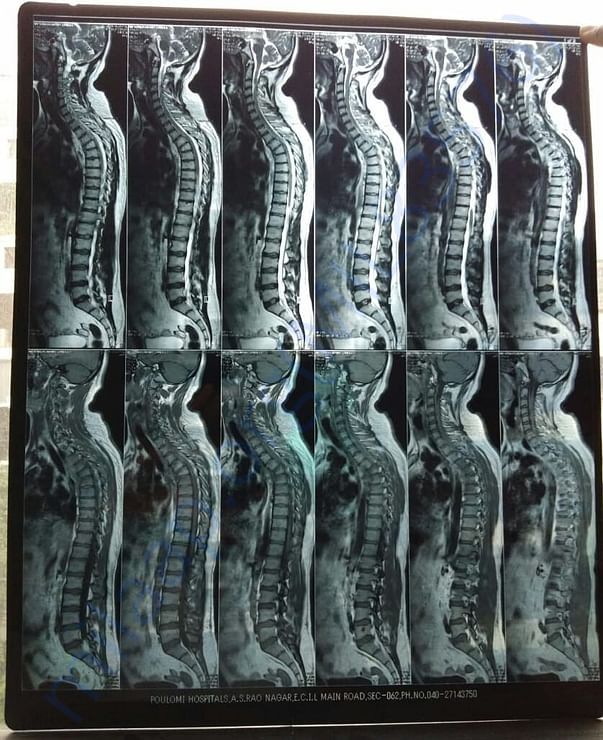 Spine2