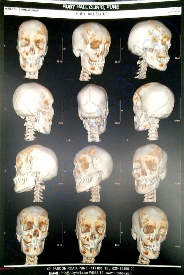 Advanced 3D CT scan for my operation