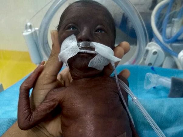 Help Premature Baby To Live