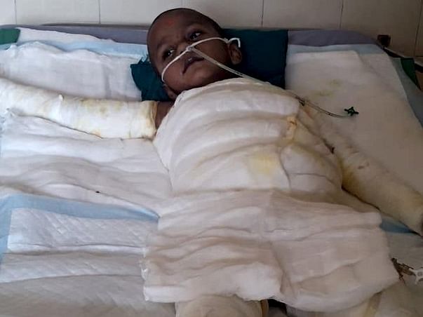 Help 4-year-old Krishive Recover From 2nd Degree Burns