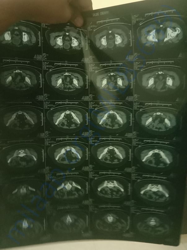 CT scan