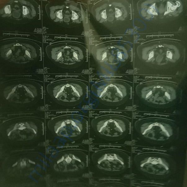 CT Scan