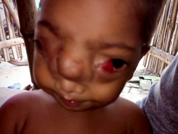 Help Jahirul Undergo Neuro surgery & plastic Surgery