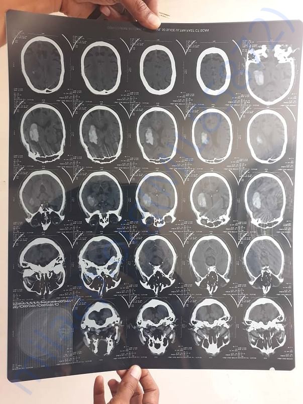 CT Scan