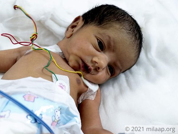 Help Baby of Naziya Undergo ASO + VSD Surgery Closure
